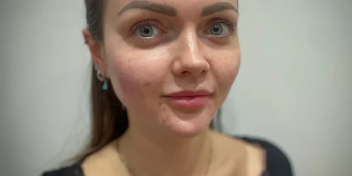 Մոռացեք ֆիլլերները. ինչու են մարդիկ դեմքին սաղմոնի սերմնահեղ...