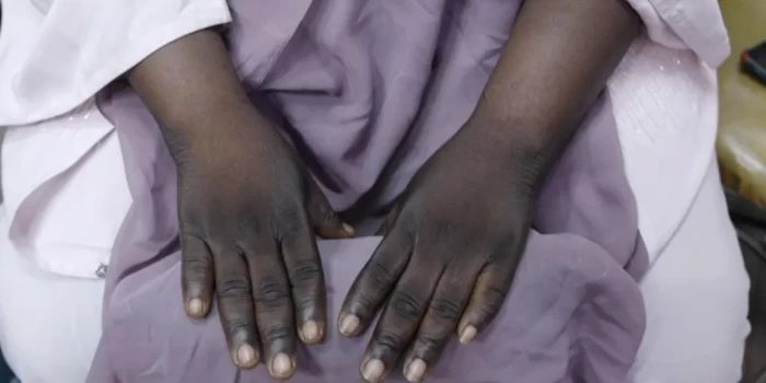 «Ես վնասել եմ իմ վեց երեխաներին՝ օգտագործելով մաշկի սպիտակեց...